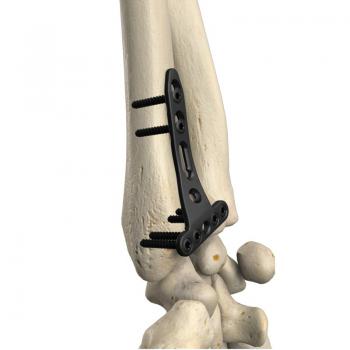 桡骨远端掌内侧锁定接骨板III型