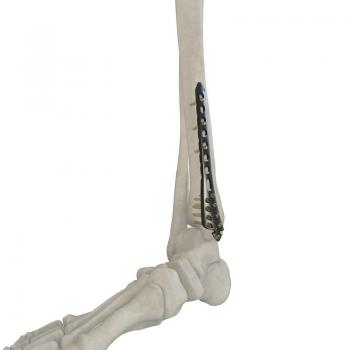 胫骨远端内侧锁定接骨板II型