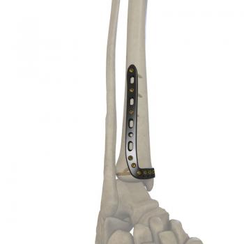 3.5mm 胫骨远端外侧（围关节）锁定接骨板