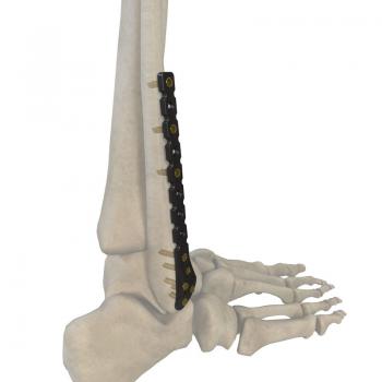 腓骨远端外侧锁定接骨板