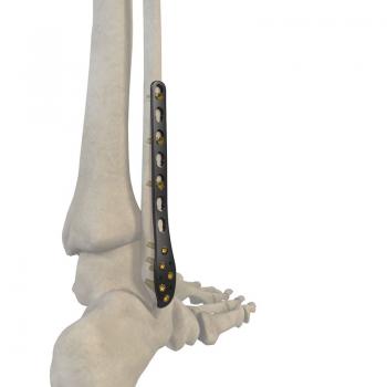 腓骨远端后外侧锁定接骨板