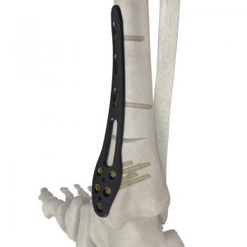 中空形胫骨截骨矫形板