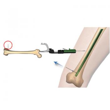 芯钻髓内钉