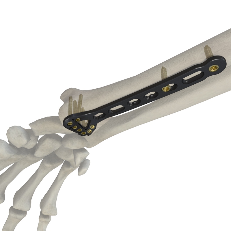 桡骨远端掌侧锁定接骨板（YAP型）